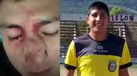 Franco Acosta fue agredido en La Loma. Es árbitro del SADRA y de la Liga Salteña (gentileza La Local)